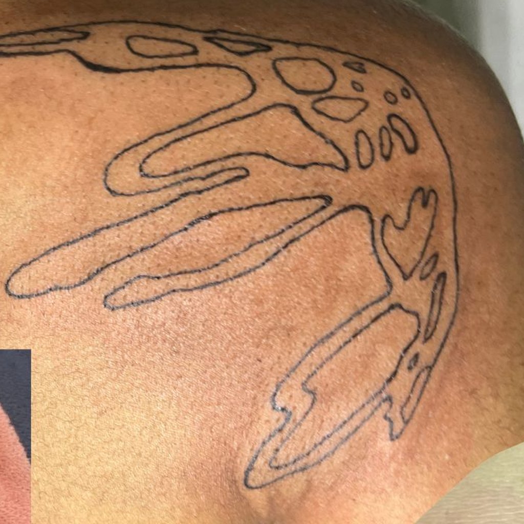 FL-10 melt — healed on skin